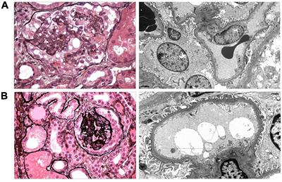 Collapsing Focal Segmental Glomerulosclerosis in Siblings With Compound Heterozygous Variants in NUP93 Expand the Spectrum of Kidney Phenotypes Associated With Nucleoporin Gene Mutations